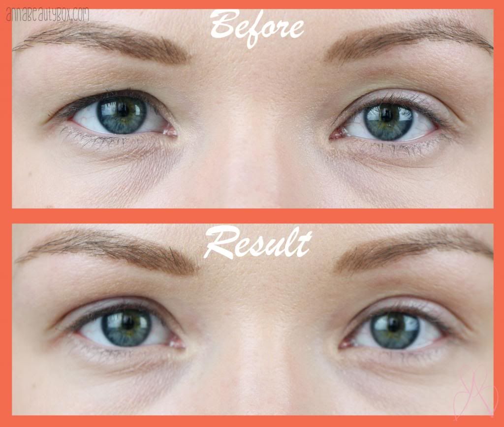 how to get rid of hanging eyelids