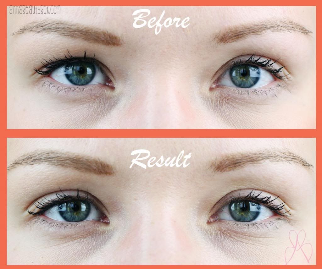 how to get rid of hanging eyelids
